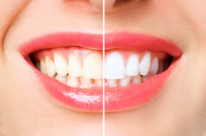 Say Goodbye to Yellow Teeth: Effective Teeth Whitening Treatments at JGHR Total Dental Care