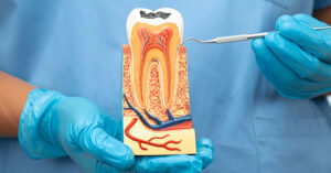 Cracked or Fractured Tooth? How Endodontic Treatment Can Save Your Smile