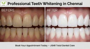 Teeth Cleaning in Chennai: The Simple Step to a Healthier Smile